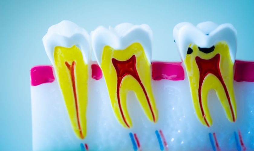 Signs May Need Root Canal