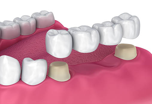 Dental bridge replacing missing tooth, supported by crowns on adjacent natural teeth