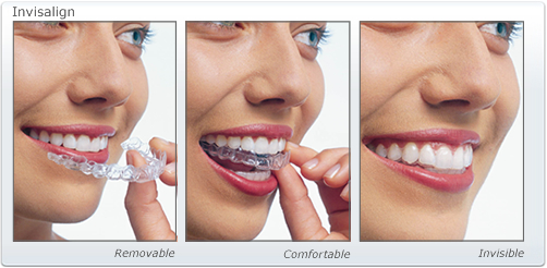Woman using Invisalign aligners – removable, comfortable, and nearly invisible.