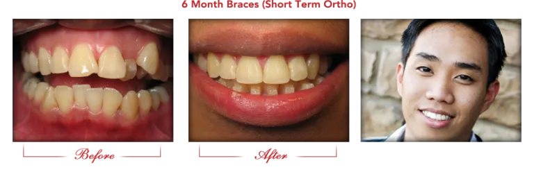 Before and after dental treatment photos showing improved tooth color and alignment with smiling patient.