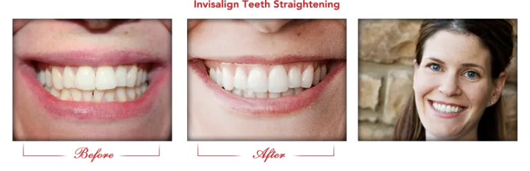 Before and after smile transformations showing teeth whitening results at Affinity Dental Queen Creek.