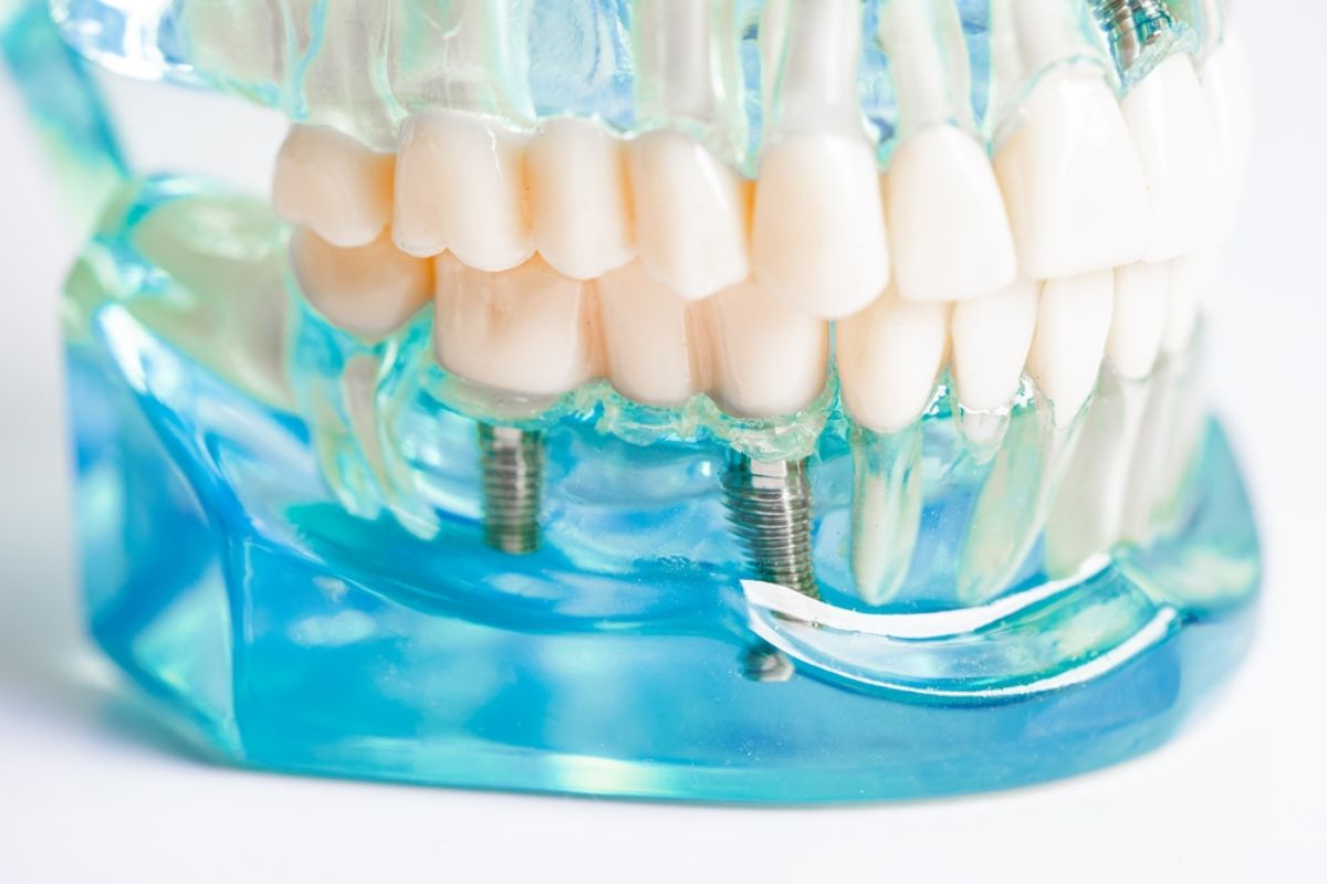 How Long After Dental Implants Can I Eat Normally