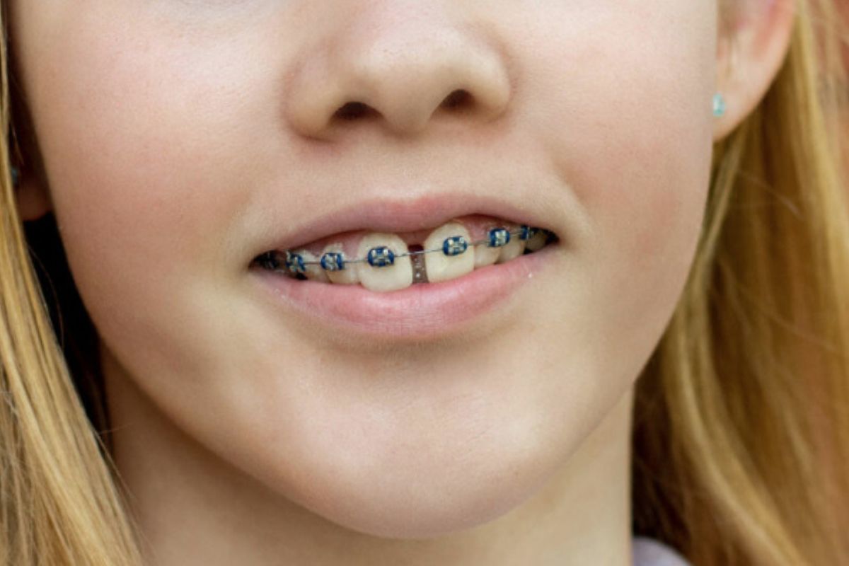 how to fix gap between teeth​