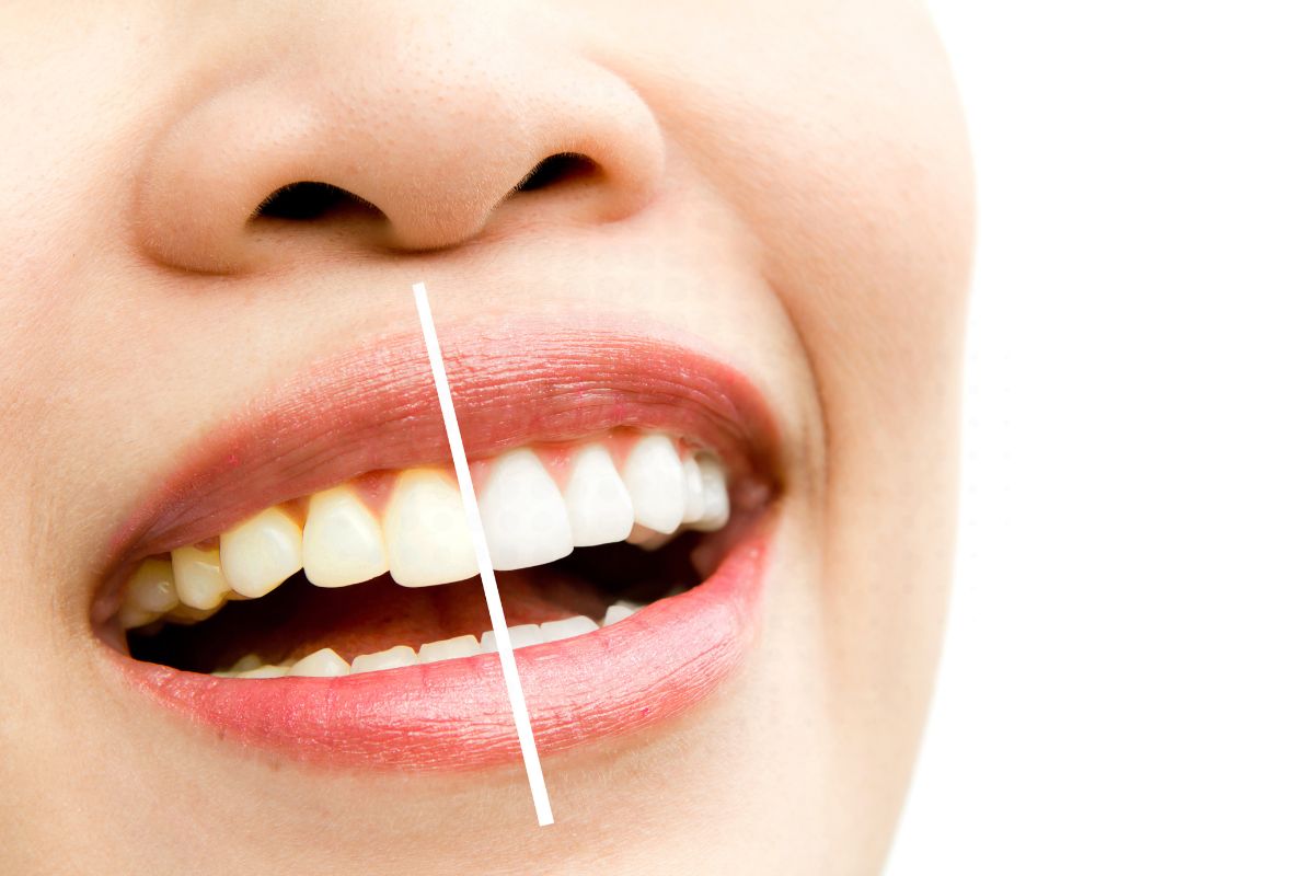 Reasons February Is the Perfect Month for Teeth Whitening